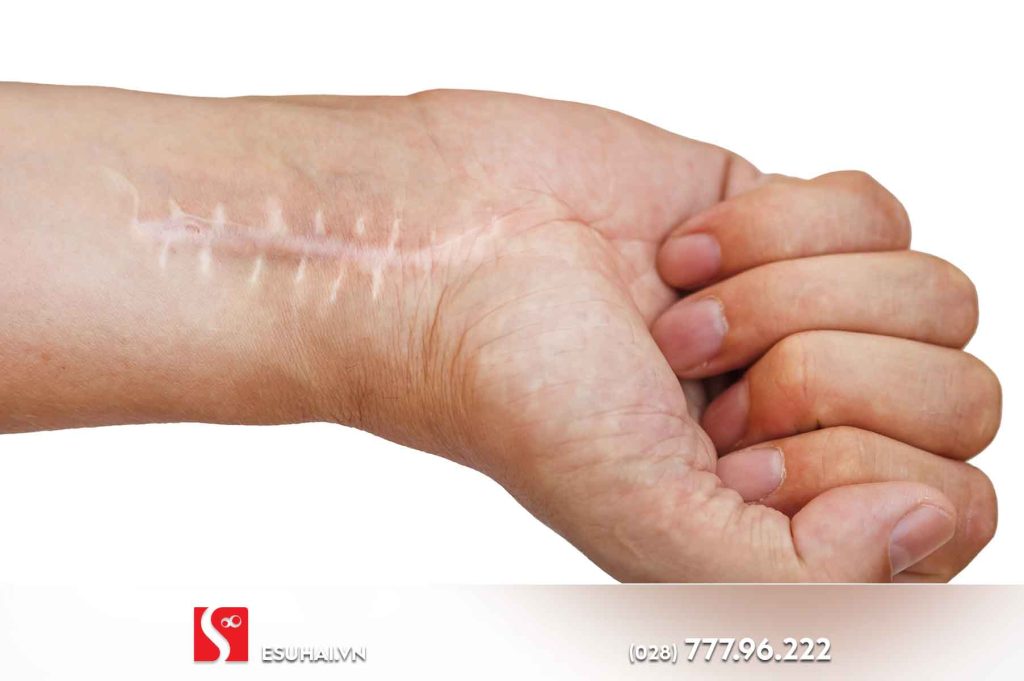 Vết sẹo không ảnh hưởng nhiều đến cơ hội việc làm, nhưng cũng tùy vị trí vết sẹo